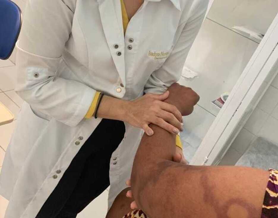 ‘Janeiro Roxo’: Prefeitura de Juazeiro realiza atendimentos para prevenção e diagnósticos da hanseníase