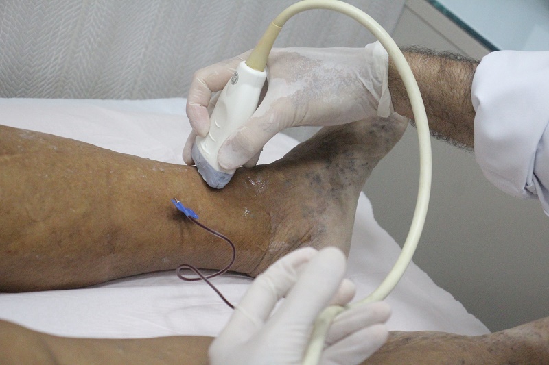 Prefeitura de Juazeiro oferece tratamento moderno e de rápida recuperação para tratamento de varizes